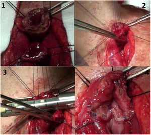 Pasos para la confección de la primera cara de la esofagosgastrostomía TM. 1) Presentación de ambos extremos terminales. 2) Colocación de puntos tractores. 3) Sección y grapado con endograpadora lineal. 4) Resultado final de la cara posterior.