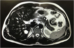 Resonancia magnética que muestra una lesión de 20mm bien delimitada hiperintensa en T2 en el cuerpo pancreático (flecha blanca) y su relación con el conducto pancreático (CP).