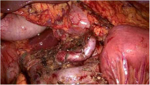 Lecho quirúrgico tras la intervención.