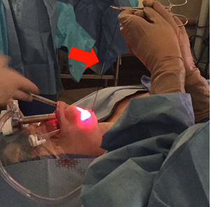 Mejora del campo con tracción cenital.