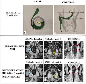 A 61-year old male patient with horseshoe fistula with additional supralevator rectal opening (SRO) at 3 o’clock position managed by cauterization of mucosa around the SRO (group-2). Panel-1: Schematic diagram-Axial section Panel-2: Schematic diagram-Coronal section. Level-A: level of intersphincteric horseshoe tract, Level-B- level of opening of SRO. Pre-operative MRI-T2 weighted images: Panel-3: Axial images at level-A showing intersphincteric horseshoe tract (blue arrow). Panel-4: Axial images at level-B showing SRO (yellow arrow). Panel-5: Coronal images showing SRO (red circle). Post-operative healed MRI-T2 weighted images (3 months after surgery). Panel-6: Axial images at level-A showing healed intersphincteric horseshoe tract (blue arrow). Panel-7: Axial images at level-B showing healed SRO (yellow arrow). Panel-8: Coronal images showing healed SRO (red circle).