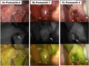 Puntuación de las glándulas paratiroides en función de la fluorescencia emitida (ICG) y que definen el grado de perfusión: glándula bien perfundida: captación blanca y homogénea (puntación 2); glándula traumática o parcialmente vascularizada: color gris/blanco heterogéneo (puntuación 1); glándula no vascularizada: color negro (puntuación 0).