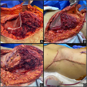 A) Se observa resección en cuña de ala ilíaca derecha (resaltada en blanco) y malla anclada con arpones. B) Descenso de músculos anchos a cresta ilíaca y confección de injerto de fascia del músculo tensor de la fascia lata (asterisco). C) Cobertura del defecto remanente con injerto para evitar exposición de la malla. D) Cierre de piel sin tensión.