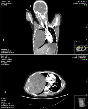 TC de tórax en la que se visualiza masa intrapulmonar heterogénea asociada a hemotórax de moderada cuantía que ocupan prácticamente la totalidad del hemitórax derecho y que condicionan importante efecto de masa con colapso completo de vasos pulmonares ipsilaterales, además de desplazamiento de estructuras mediastínicas. A) Corte coronal. B) Corte axial.