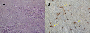 A) H&E: Proliferación de fibroblastos sin datos de malignidad e inflamación crónica entremezclada con predominio de células plasmáticas. B) IHQ: Células plasmáticas positivas para IgG4 (flechas amarillas).