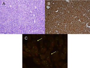 A) H&E: Proliferación celular fibrohistiocitaria, que se dispone en fascículos cortos o estoriformes con un prominente infiltrado inflamatorio acompañante. No se observa necrosis ni permeación vascular. B) IHQ: Tinción de inmunohistoquímica positiva para ALK. C) FISH: Translocación para el gen ALK (flechas amarillas).