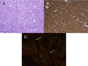 A) H&E: Proliferación celular fibrohistiocitaria, que se dispone en fascículos cortos o estoriformes con un prominente infiltrado inflamatorio acompañante. No se observa necrosis ni permeación vascular. B) IHQ: Tinción de inmunohistoquímica positiva para ALK. C) FISH: Translocación para el gen ALK (flechas amarillas).