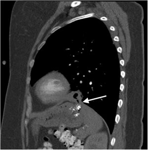 Proyección sagital TC. Se observa el fundus gástrico adherido al hemidiafragma izquierdo y el paso de una burbuja aérea (flecha) hacia la cavidad pleural a nivel del LII. LII: lóbulo inferior izquierdo; TC: tomografía computarizada.