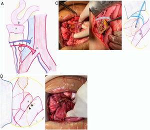 A. Figura esquemática del trasplante pancreático. a: segmento duodenal del injerto pancreático; b: anastomosis bicapa L-L manual entre el duodeno (injerto) y el yeyuno (receptor) a 60cm del ligamento de Treitz; c: anastomosis porto-cava T-L; d: reconstrucción arterial en «Y» mediante cirugía de banco, utilizando injerto de arteria iliaca del donante anastomosando la arteria mesentérica superior y esplénica; se realiza anastomosis T-L con la arteria iliaca primitiva derecha. B. Dehiscencia de anastomosis duodeno-yeyunal. a: segmento duodenal del injerto pancreático. Flechas negras: perforaciones de la anastomosis duodeno-yeyunal. C. Técnica quirúrgica realizada. a: duodenectomía (del injerto) y resección de la anastomosis duodeno-yeyunal; b: tutorización externa del conducto de Wirsung; c: restitución del tránsito intestinal mediante anastomosis T-T manual yeyuno-yeyunal.