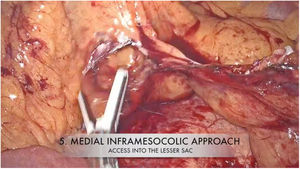 Liberación del ángulo esplénico con abordaje medial inframesocólico laparoscópico.