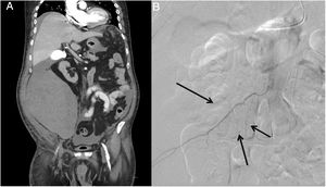 A) Hematoma retroperitoneal derecho. B) Sangrado activo arterial dependiente de ramas lumbar L1, ileolumbar y circunfleja ilíaca (flechas).