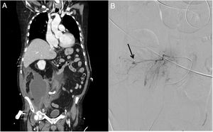A) Hematoma retroperitoneal derecho. B) Sangrado activo arterial dependiente de ramas lumbar L3-4 e ileolumbar (flecha).