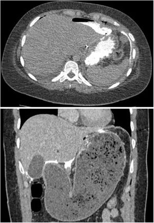 TC abdominal (cortes axial y coronal) que muestra fuga del contraste oral.