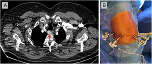 (A) Computed tomography showed a 19mm×16mm×32mm nodule in the upper posterior mediastinum, retrotracheal and right paraesophageal (red arrow). (B) Four robotic operating ports of 8mm in the same intercostal space.