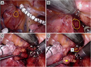 (A) “1” right subclavian artery; “2” internal thoracic artery; “3” phrenic nerve; “4” superior vena cava; “5”: acygos vein; “6” vagus nerve. Yellow circle shows the imprint of the tumour on the mediastinal pleura. (B) Yellow circle shows the tumour. (C) The tumourwas extracted with an endoscopic babcock forceps. (D) Yellow star shows the resected tumour and “7” right common carotid artery.