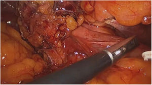 Fístula colecistoduodenal (síndrome de Mirizzi tipo 5a).