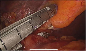 Sección de fístula colecistoduodenal (síndrome de Mirizzi tipo 5a) con sutura mecánica.