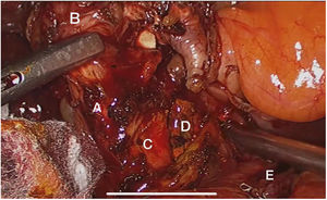 Síndrome de Mirizzi tipo 5a (fístula colecistoduodenal) asociado a coledocolitiasis. A) Conducto cístico. B) Vesícula biliar. C) Coledocotomía. D) Cálculo en el colédoco. E) Borde de sección duodenal posterior a la resección de la fístula.