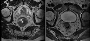 Cortes axiales de RM. A la izquierda, tumor de recto localizado en vertiente lateral izquierda (rmT2). A la derecha, tumor que invade la superficie serosa (zona marcada con asterisco) a nivel anterior (rmT4a). Las flechas señalan la reflexión peritoneal.