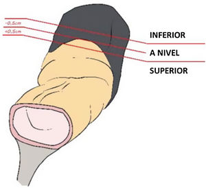 Esquema de la pieza quirúrgica que muestra la superficie serosa en naranja y la grasa mesorrectal en negro, con las referencias para clasificar los tumores respecto a la RP.