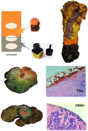 Protocolo de tinción de la pieza quirúrgica. Se pinta la grasa mesorrectal con tinta china y la superficie serosa con colorante naranja. En la parte inferior, cortes axiales de 2 piezas quirúrgicas diferentes y cortes histológicos que muestran afectación del borde de resección a nivel del colorante naranja (T4a) y de la tinta china (MRC afecto). Las flechas señalan el frente tumoral tanto en los cortes macroscópicos como microscópicos.