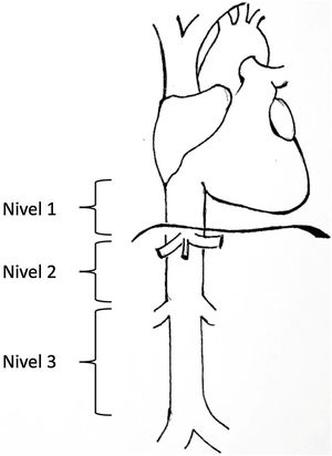 Niveles de afectación según la clasificación de Kulaylat et al.4.
