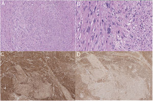 Histopatología de leiomiosarcoma cava: A) Hematoxilina y eosina (H&E) ×10; B) H&E ×40; C) Inmunohistoquímica con desmina ×4; D) Inmunohistoquímica con AML ×4.