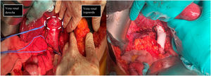 En la primera imagen muestra el momento de la identificación de estructuras previo a la extirpación de leiomiosarcoma. Se describe el control vascular en cava retrohepática, infrarenal y ambas venas renales previo a extirpación tumoral (tumor señalado con línea discontinua blanca). En la segunda imagen se evidencia la presencia de prótesis de PTFE en sustitución de VCI se han preservado ambas venas renales, reinsertando la izquierda.