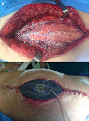 Cierre por tracción fascial y terapia de presión negativa.