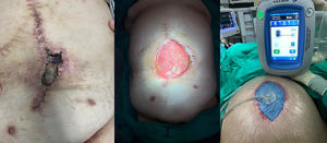 Manejo conservador de la infección de prótesis utilizando terapia de presión negativa. Lavado quirúrgico de la herida y del espacio suprafascial donde está alojada la malla. Posterior colocación de dispositivo de de vacío.