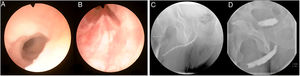 Cistoscopia que muestra estenosis uretral con afectación desde uretra distal (A) hasta veru montanum (B). Uretrografía retrógrada con estenosis panuretral, imagen preoperatoria (C) y a los 3 meses de la cirugía (D).