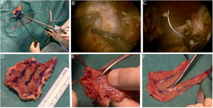 Extracción de injerto de mucosa rectal mediante cirugía mínimamente invasiva transanal (TAMIS) con plataforma GelPOINT® (A). Disección hasta el estrato circular de la túnica muscularis (B) y cierre con sutura longitudinal barbada V-Loc™ 3-0 (C). Parche rectal extraído (D), separación de la mucosa rectal (E) y tallado de la misma en forma de «N» que consigue un injerto longitudinal libre de 22×1,5cm (F).