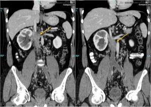 Tomografía computarizada preoperatoria: cortes coronales. Se observa tumoración afectando VCI y VR derecha y trombosis completa de venas ilíacas comunes y VCI, hasta nivel infrarrenal.
