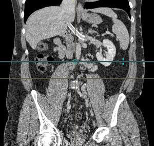 Tomografía computarizada a los cuatro años de cirugía. Corte coronal. No signos de recidiva. Se observa prótesis vascular permeable.