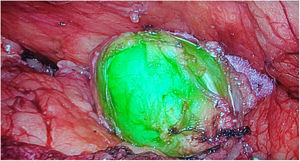Identificación de Schwannoma.