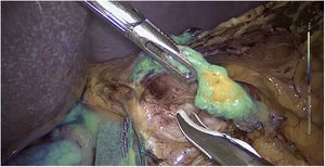 Adenopatía sobre la arteria hepática en cirugía gástrica. Punción 24h antes.