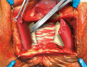 Disección del espacio interesfinteriano.