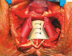 Esfinterorrafia del esfínter anal interno.