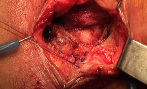 Plastia anal.