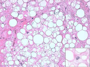 Liposarcoma bien diferenciado H-E 100×. Adipocitos maduros con variaciones significativas en su tamaño y tractos fibrosos con células estromales atípicas. Inset: célula estromal atípica a mayor aumento (400×).