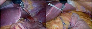 Liver retraction with the magnetic grasper attached to the silastic tube and attached directly to the left liver lobe.