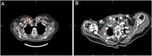 TAC cervical preoperatorio (A) y postoperatorio tras ser reconstruida la lesión (B).Flecha roja: trayecto carotídeo; flecha naranja: adenopatía; flecha azul: prótesis PTFe; flecha verde: arteria subclavia permeable distal al by-pass.