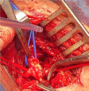 Aspecto intraoperatorio de la lesión a nivel de la arteria subclavia proximal, marcada con vessel-loop azul; arteria carótida marcada con vessel-loop rojo.