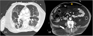 (A) Computed tomographic angyography (CTA) of the chest showing bilateral ground-glass opacities and bibasilar areas of consolidation. (B) CT-angiographic image showing a large mural thrombus extending from the infrarenal aorta into the inferior mesenteric artery (arrow) and pneumoperitoneum (asterisk).