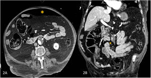 (A) CT-angiography image showing large mural thrombus of the infrarenal aorta (arrow) and pneumoperitoneum (asterisk). (B) Coronal CT-angiography depicting thrombus of the aorta (arrow) and pneumoperitoneum (asterisk).