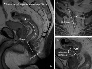 Representación gráfica de la medición por resonancia magnética de un tumor de tercio superior de recto (cT3a N1Mx). A. Plano sagital: distancia del tumor al margen anal (límite inferior del esfínter anal externo) (113mm) mediante suma de líneas discontinuas. B. Plano axial: longitud craneocaudal del tumor (54,8mm) y presencia de adenopatía en grasa mesorrectal (cN1). C. Plano sagital: localización de la reflexión peritoneal anterior y relación con el tumor.