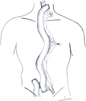 Yeyunoplastia supercharged.