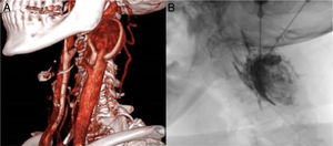 (a) Reconstrucción 3D de angio-TC que muestra tumor hipervascularizado en la bifurcación carotídea izquierda. (b) Embolización mediante punción directa de Onyx®.