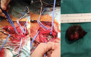 (a y b) Imágenes intraoperatorias finalizando la exéresis del tumor (c). Paraganglioma extirpado.