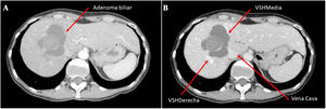 Angiografía por tomografía computarizada (angio-TC), en la que se observa lesión hepática quística polilobulada, septada, localizada entre segmentos vii-viii, de un tamaño aproximado de 6,5×6×6,5cm. A) Fase arterial. Flecha: adenoma biliar. B) Fase portal. Flechas: vena suprahepática (VSH) derecha, VSH media, vena cava.